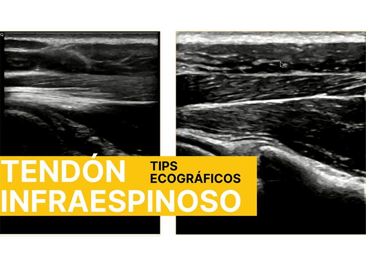 tendon-infraespinoso-ecografia-con-adrian-benito